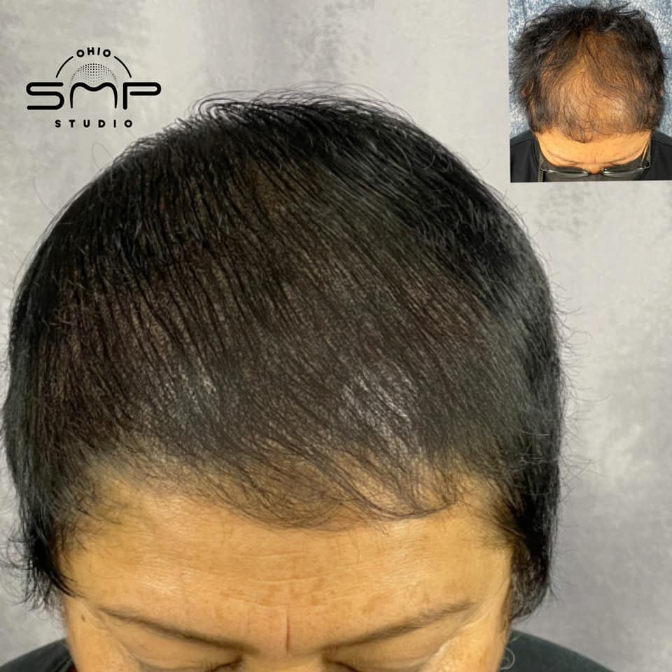 Birth Control And Hair Loss Understanding The Link Ohio SMP Studio