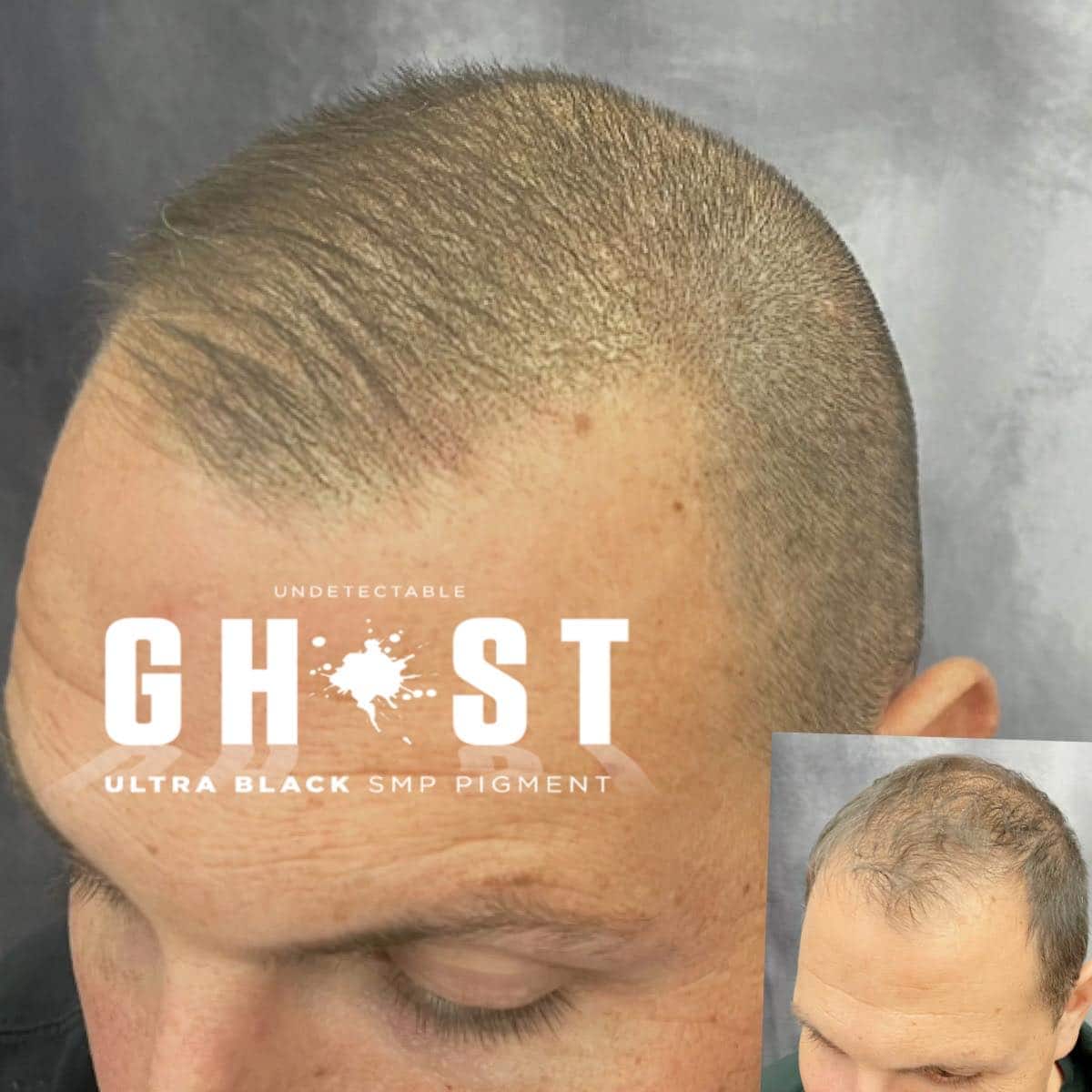 Hair Loss Solutions in Columbus, OH Restoring Confidence and Quality