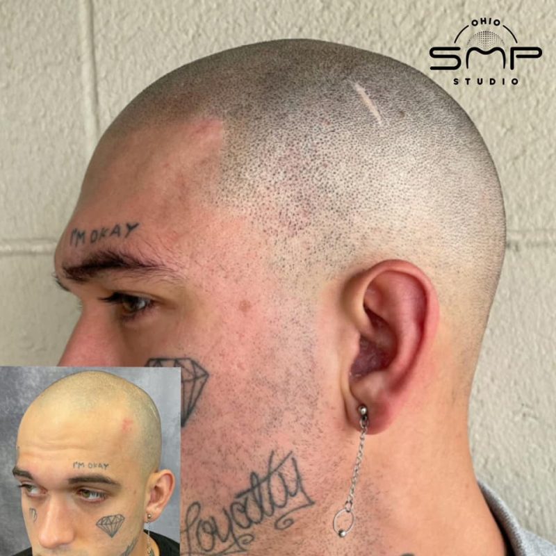 Unveiling the Truth About Baldness and HatWearing SMP Solutions in