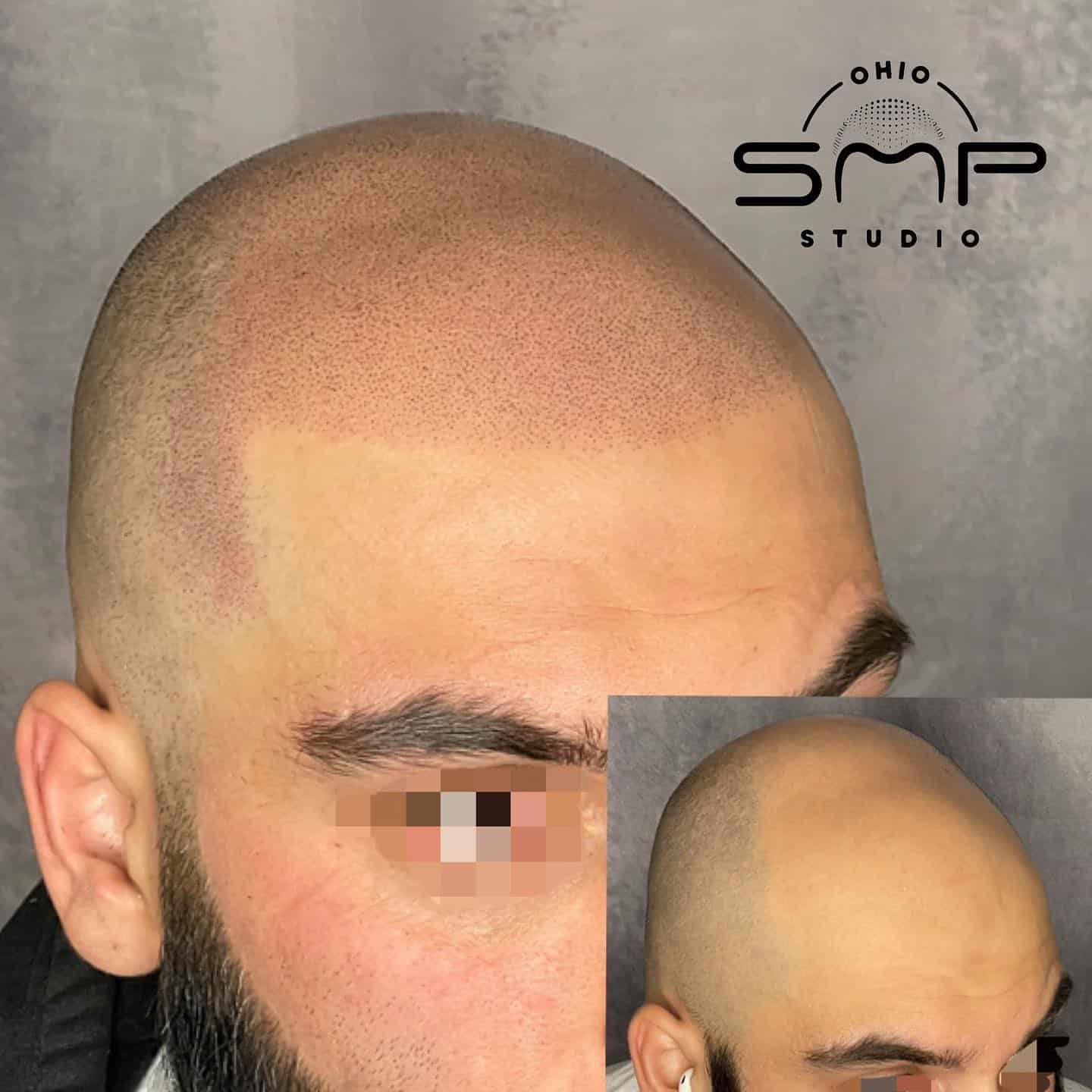 Unveiling the Art of SMP Aftercare and Skin Health in Columbus, OH