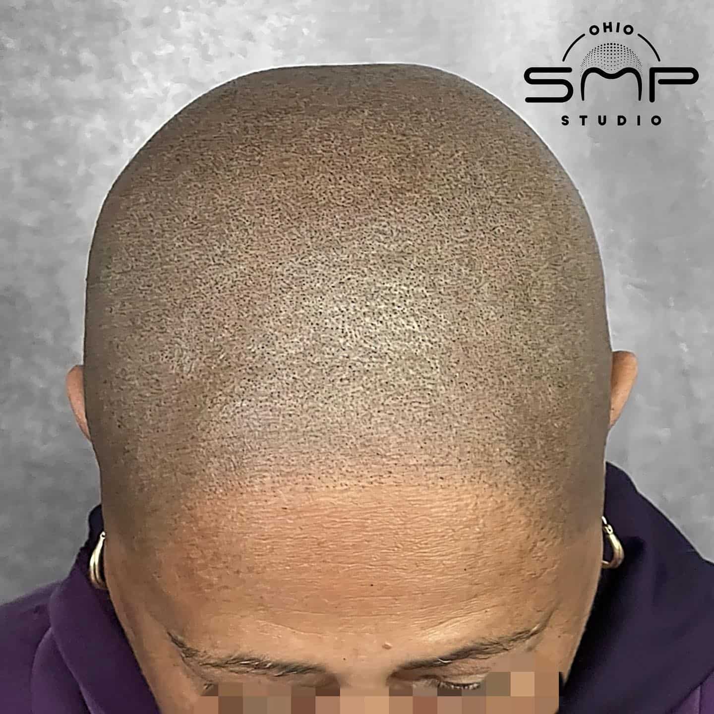 Discover the Natural Beauty of Scalp Micropigmentation in Columbus, OH