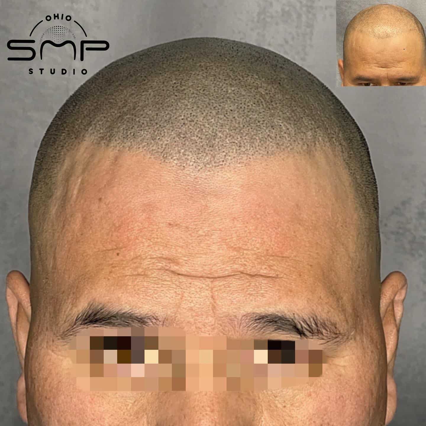Rediscover Confidence with Scalp Micropigmentation in Columbus, OH