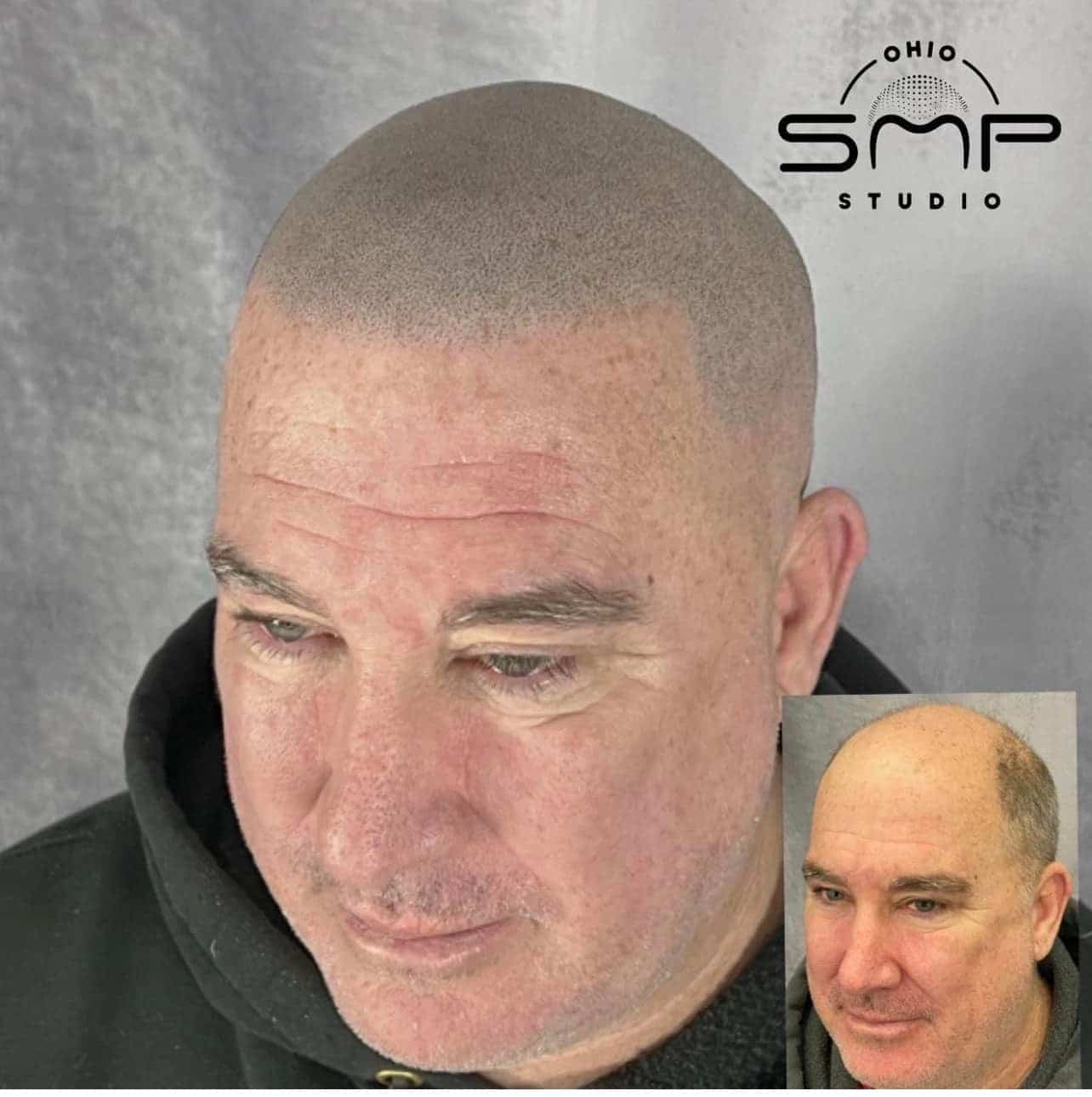 Affordable Scalp Micropigmentation Financing in Columbus, OH Your Path