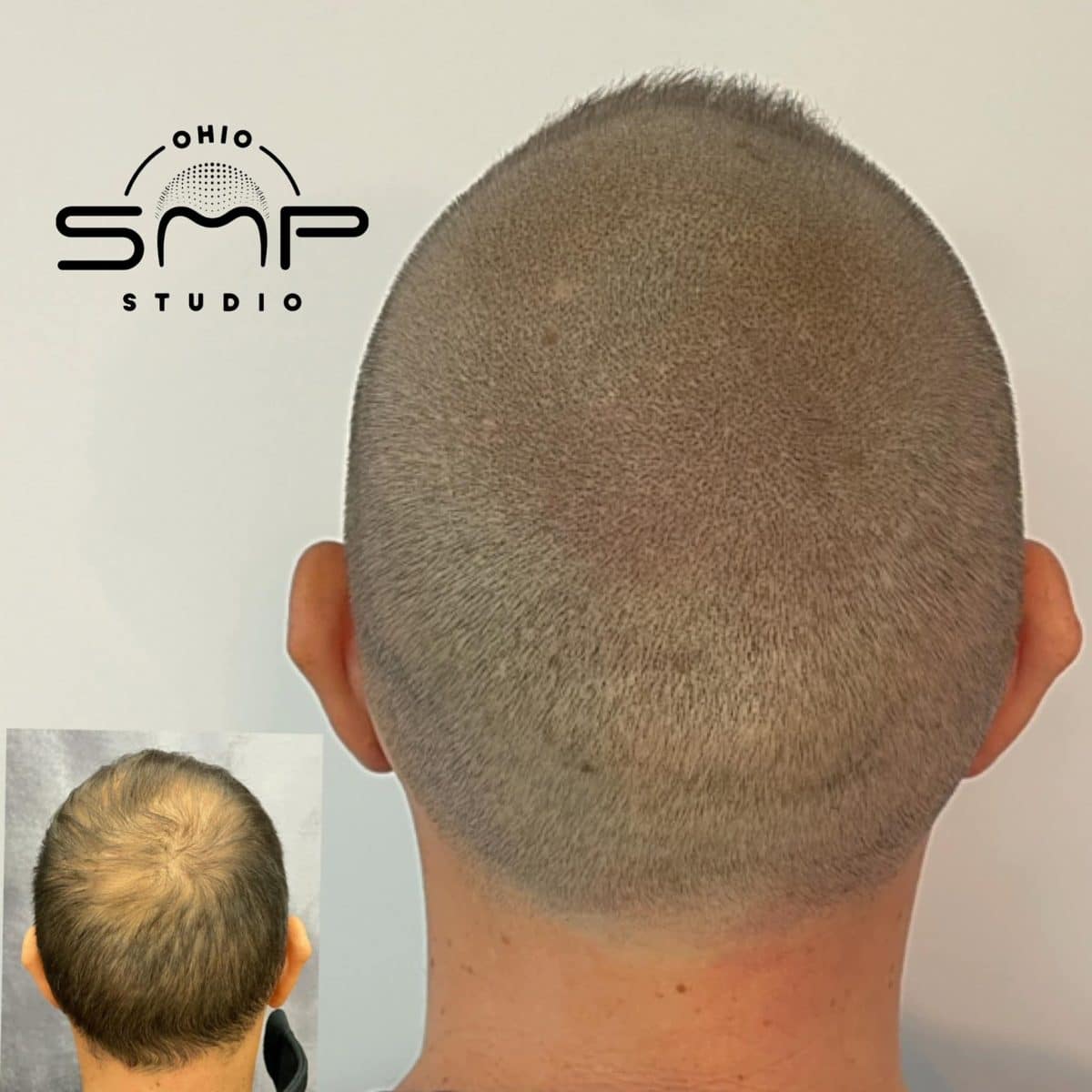 Transforming Lives with Scalp Micropigmentation Ohio SMP Studio's