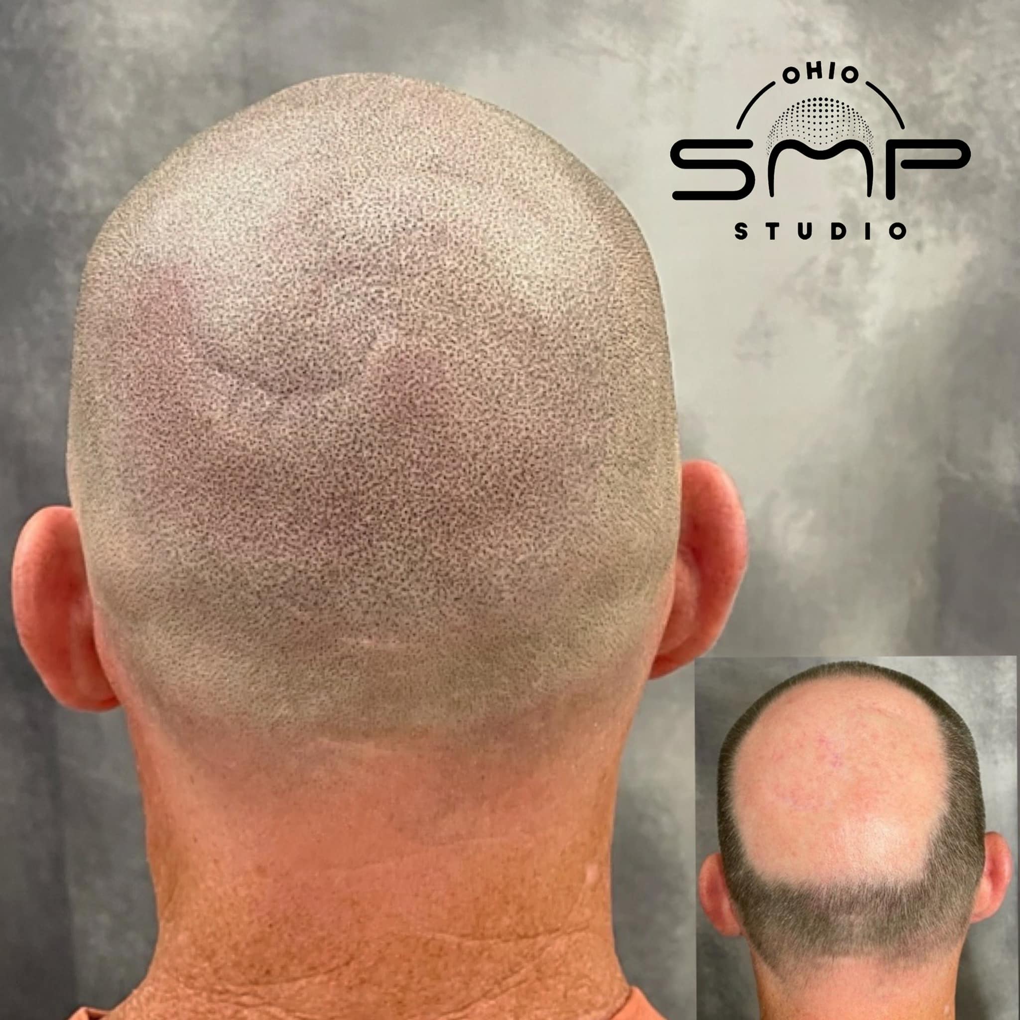 Discover Scalp Micropigmentation The Ultimate Hair Loss Solution in Houston, TX at Ohio SMP