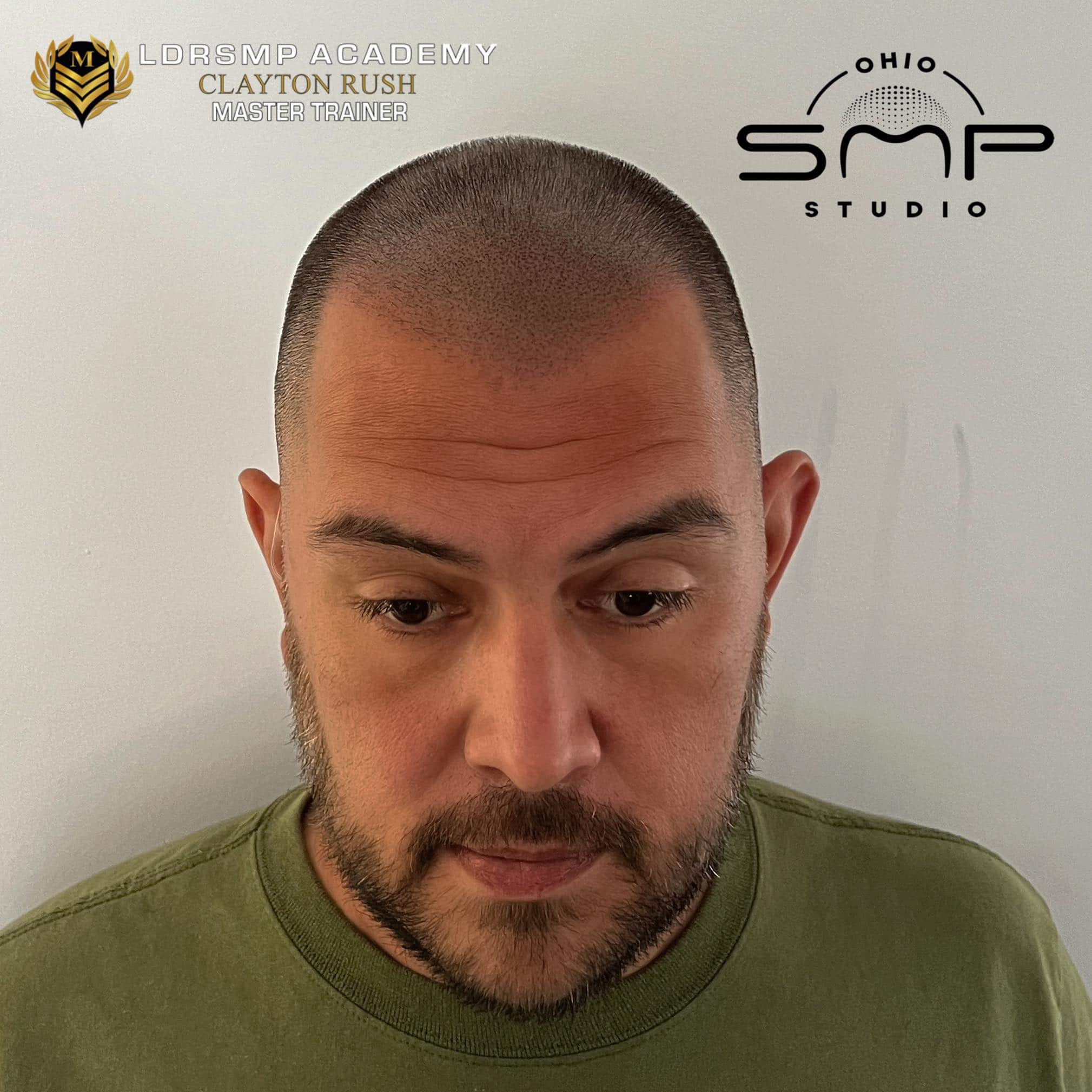 Navigating Balding: A Guide for Single Men in 2023 | Ohio SMP Studio