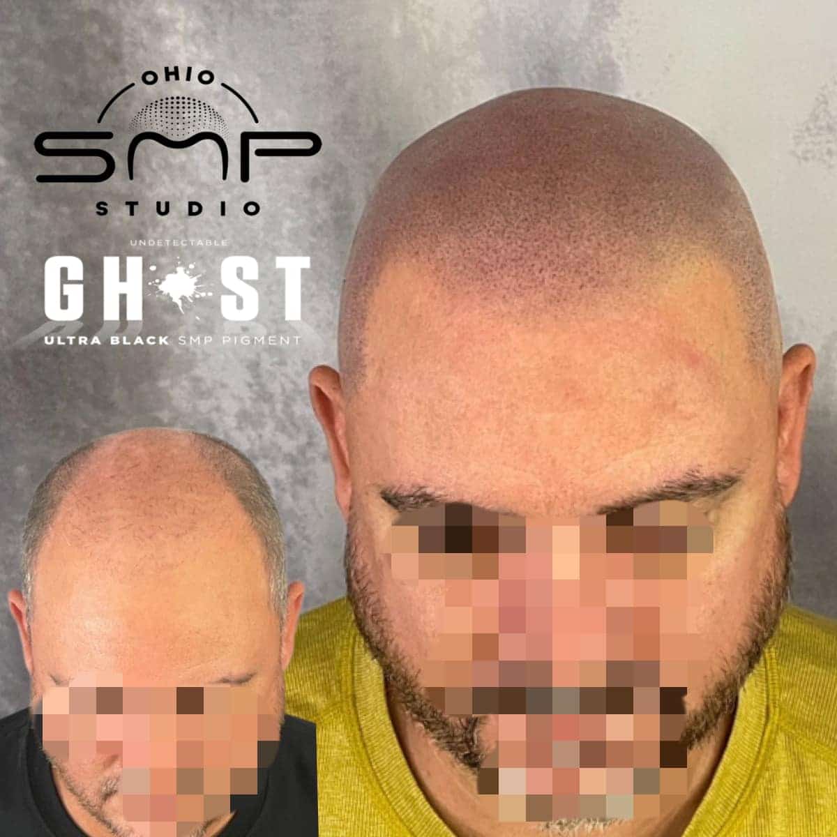 Unlocking the Connection Dry Scalp and Hair Loss Insights in Columbus, OH