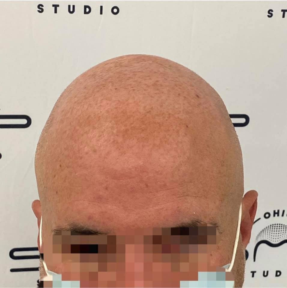 Unveiling the Truth About Comb Overs and Hair Loss Coverups in Columbus, OH