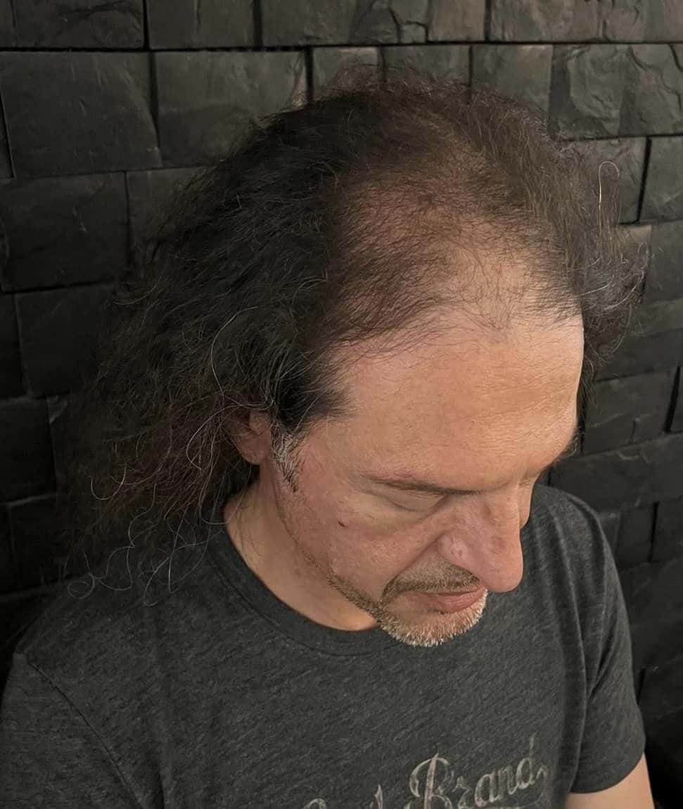 Exploring Hair Loss Solutions Shave or Try Scalp Micropigmentation in