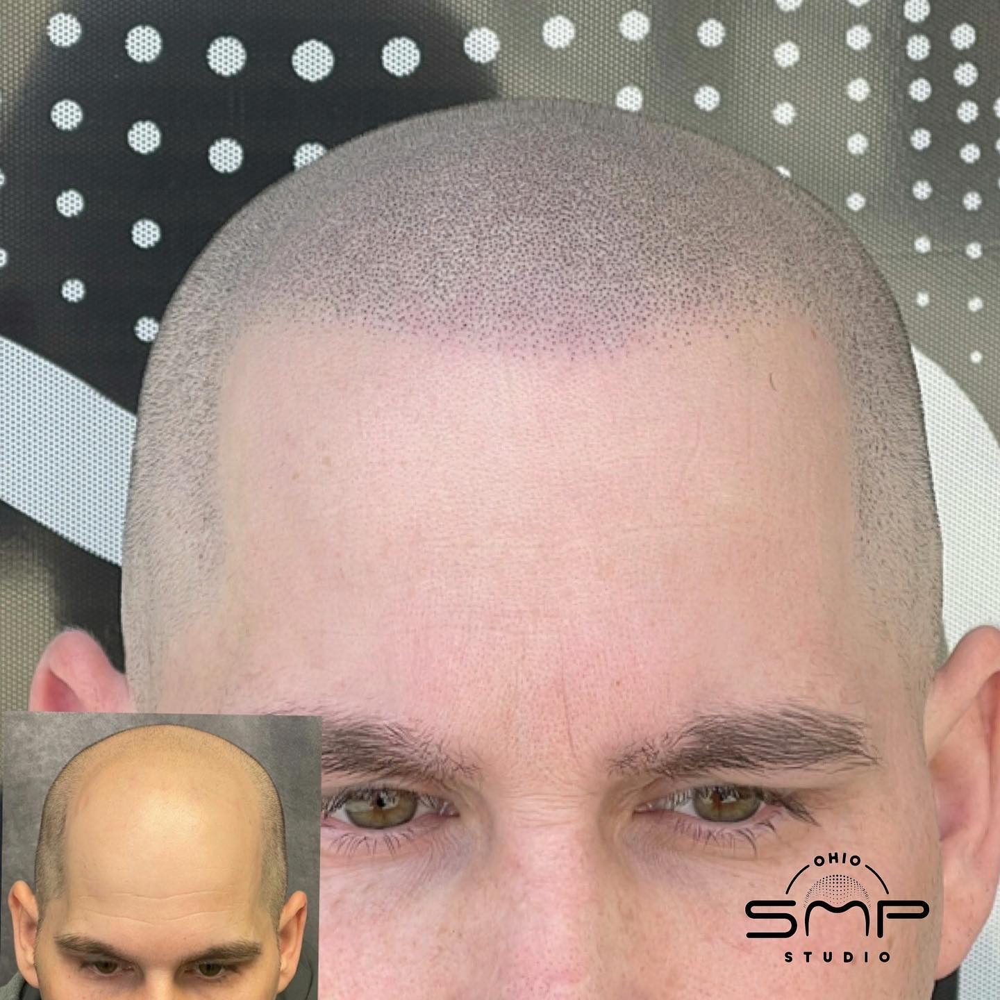 Discover the Best Hair Loss Treatments in Columbus, OH SMP Studio