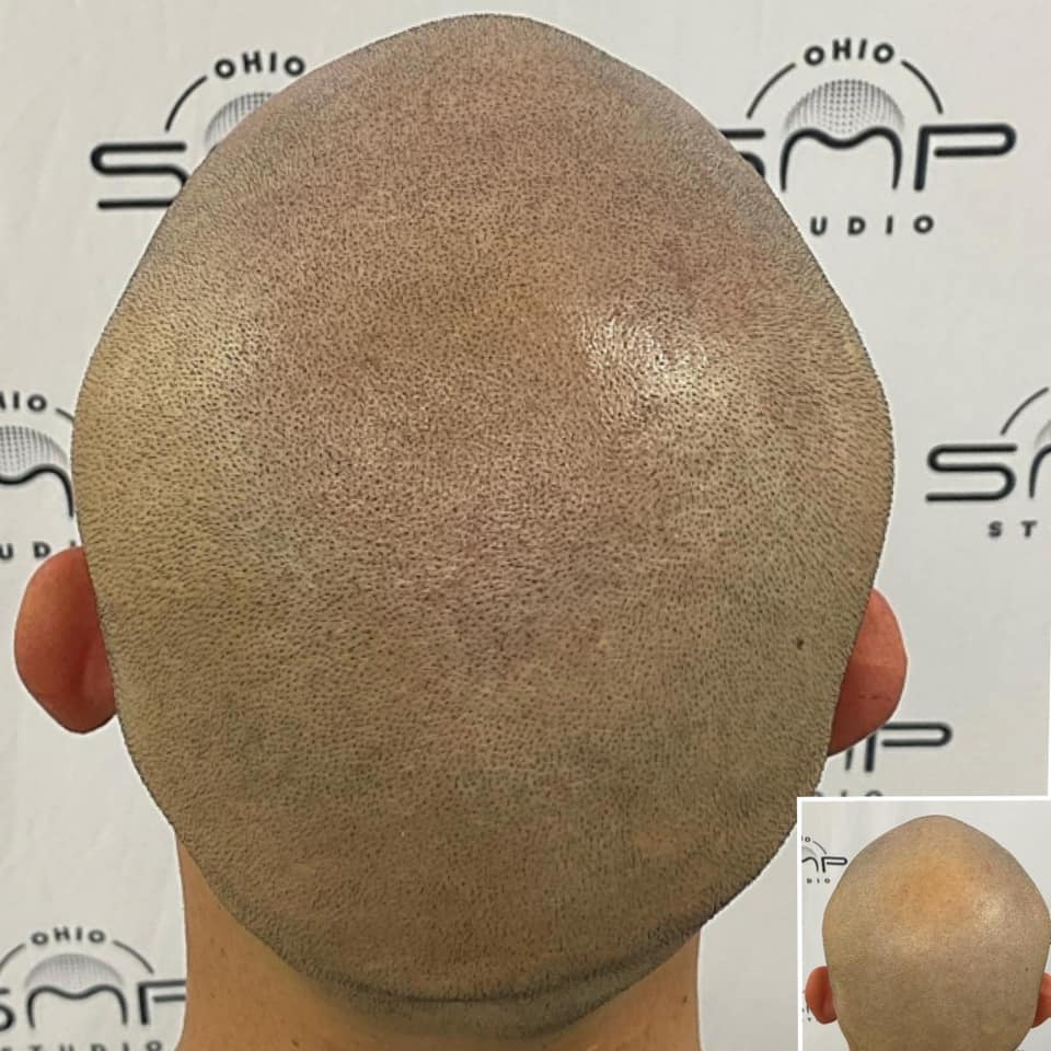 Transform Your Look with Scalp Micropigmentation in Columbus, OH Ohio
