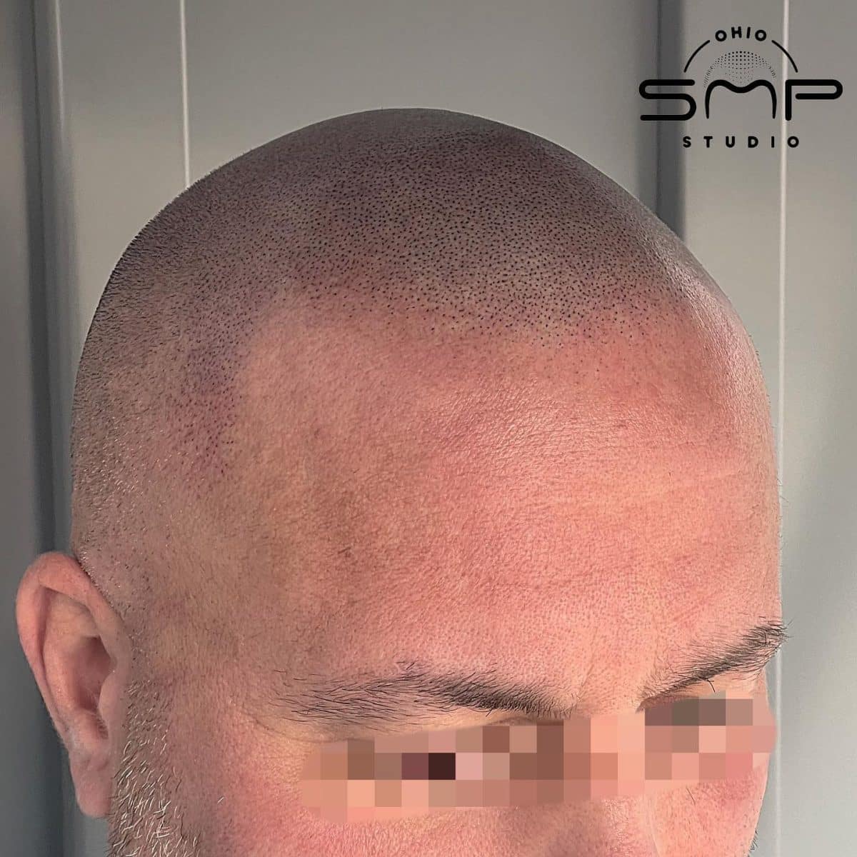 Unveiling the Truth Do Hats Really Cause Hair Loss?