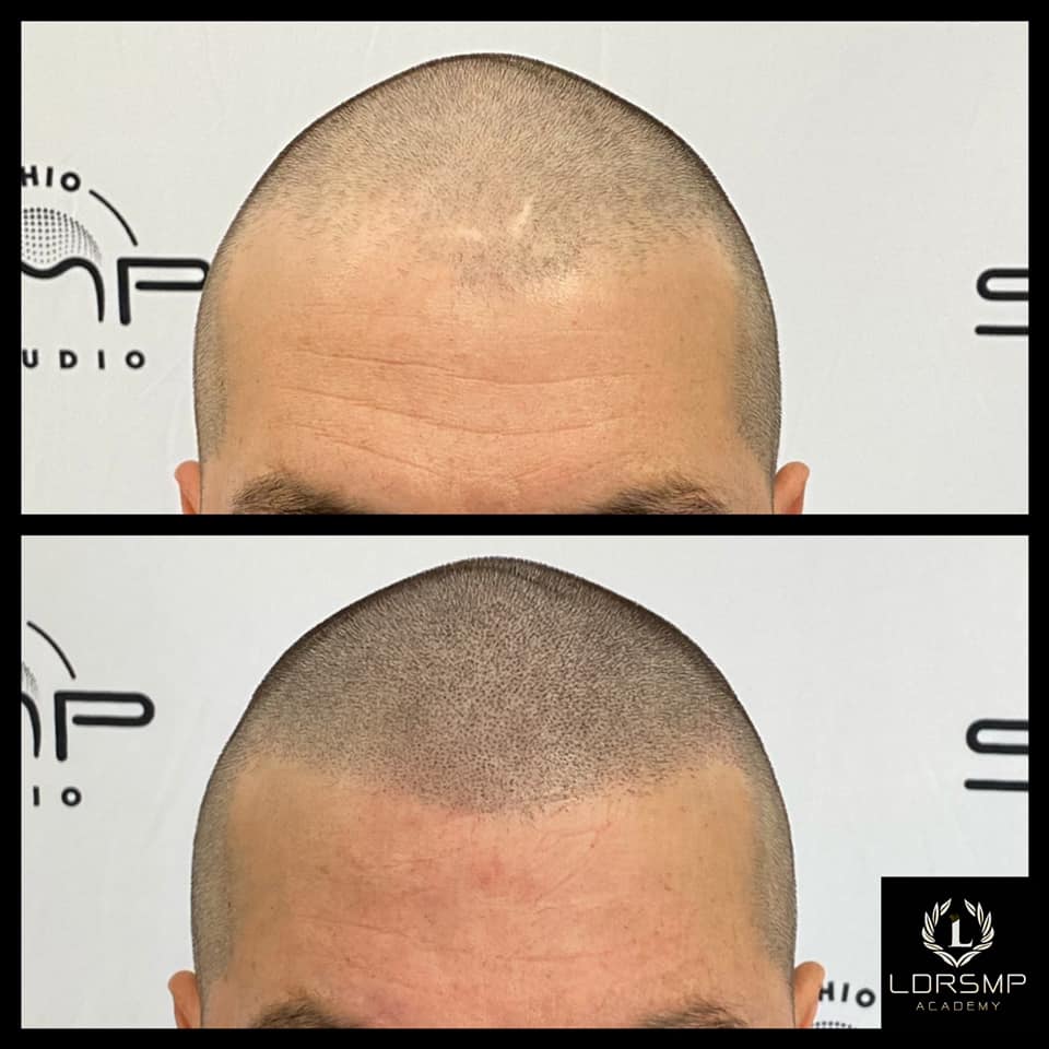 Revive Your Look Discover Scalp Pigmentation at Ohio SMP Studio in