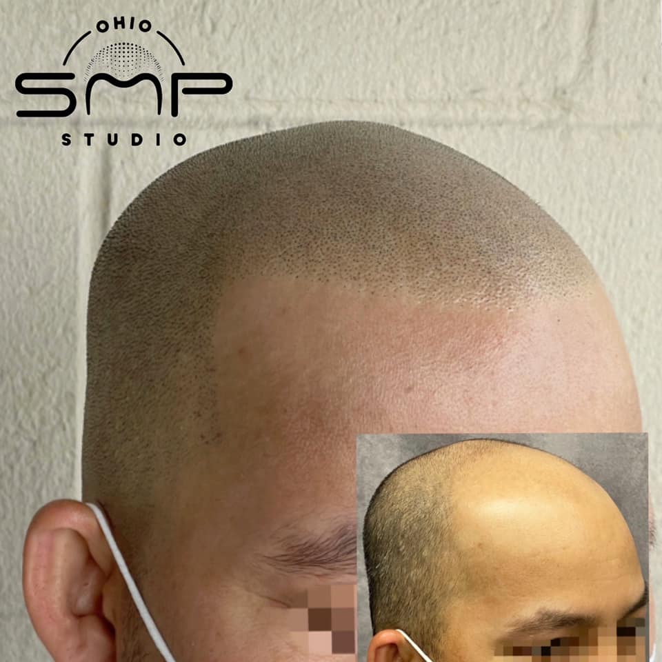 Regain Confidence with Scalp Micropigmentation in Columbus, OH Ohio