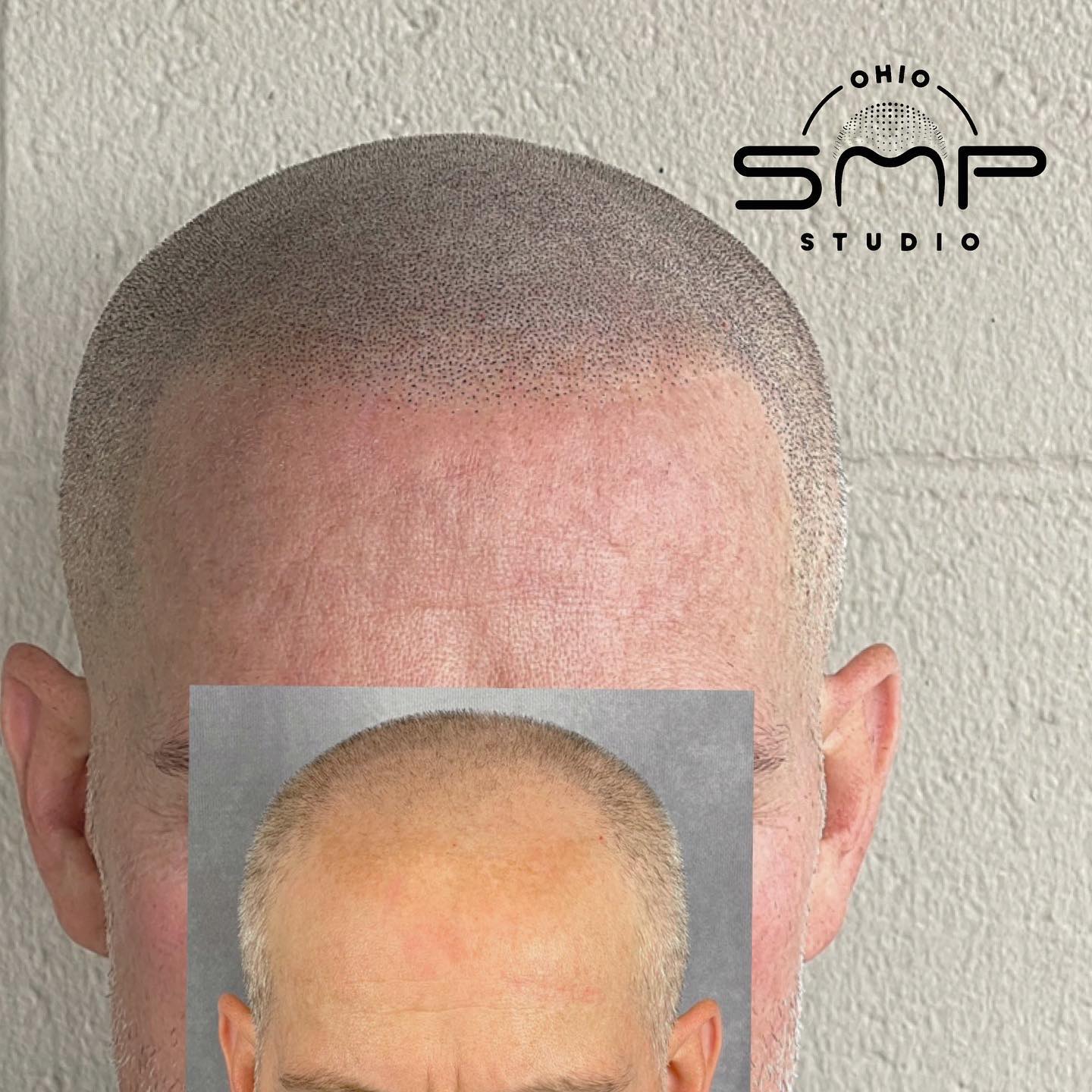 Discover the Transformative Power of Scalp Micropigmentation in