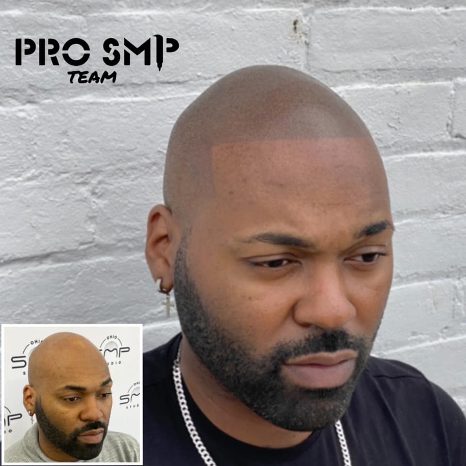 Non Surgical Hair Loss Treatment In Columbus OH Experience The non-surgical-hair-loss-treatment-in-columbus-oh-experience-the