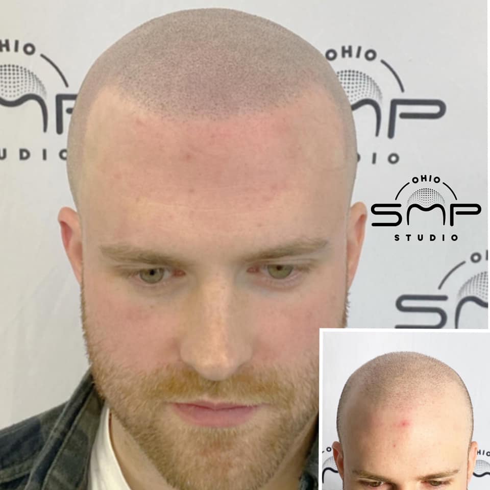 Transform Your Look with NonSurgical Hair Restoration in Columbus, OH