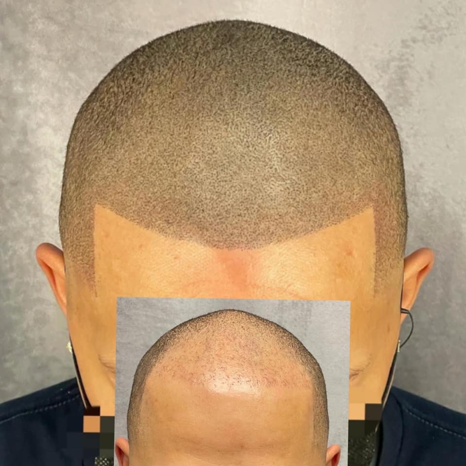 Transformative SMP Hair Loss Treatment in Columbus, OH Unraveling the