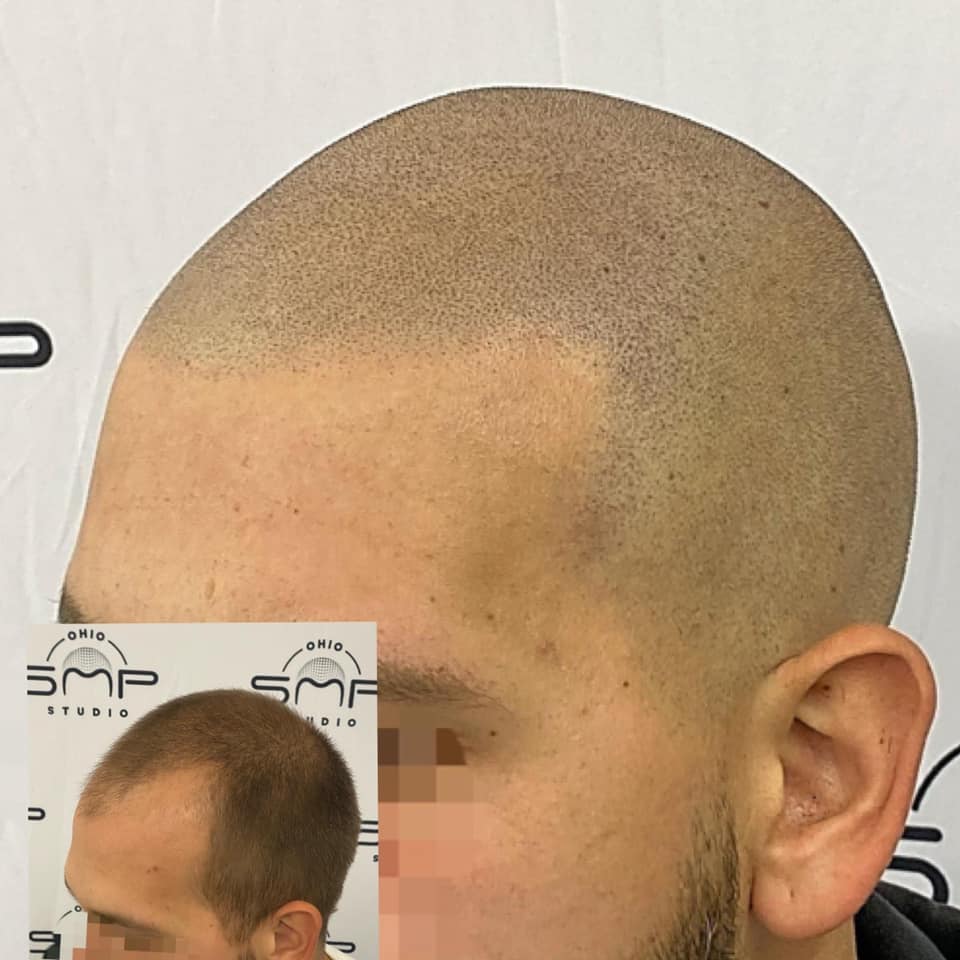 Revitalize Your Look with Scalp Micropigmentation in Columbus, OH