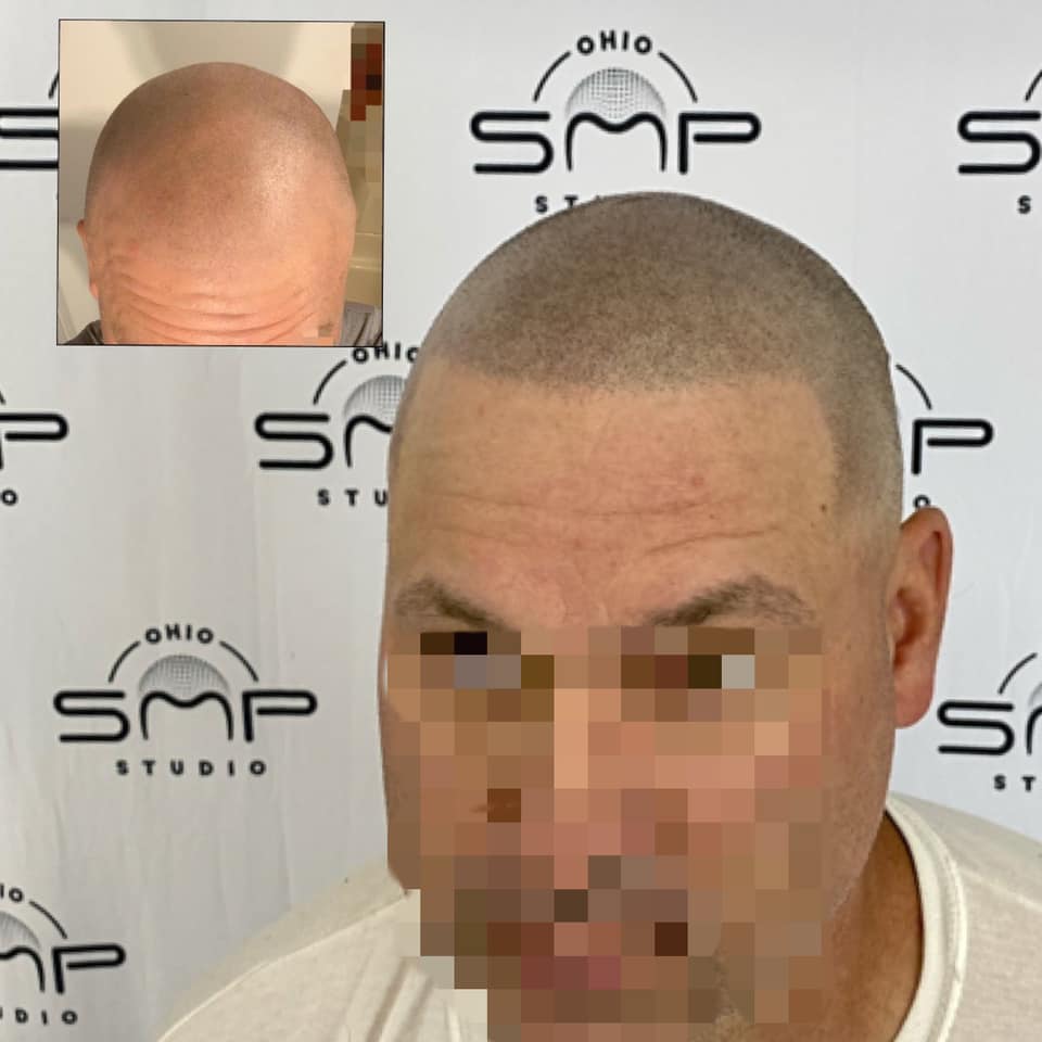Unlocking the Secrets of Scalp Micropigmentation in Houston & Austin, Texas