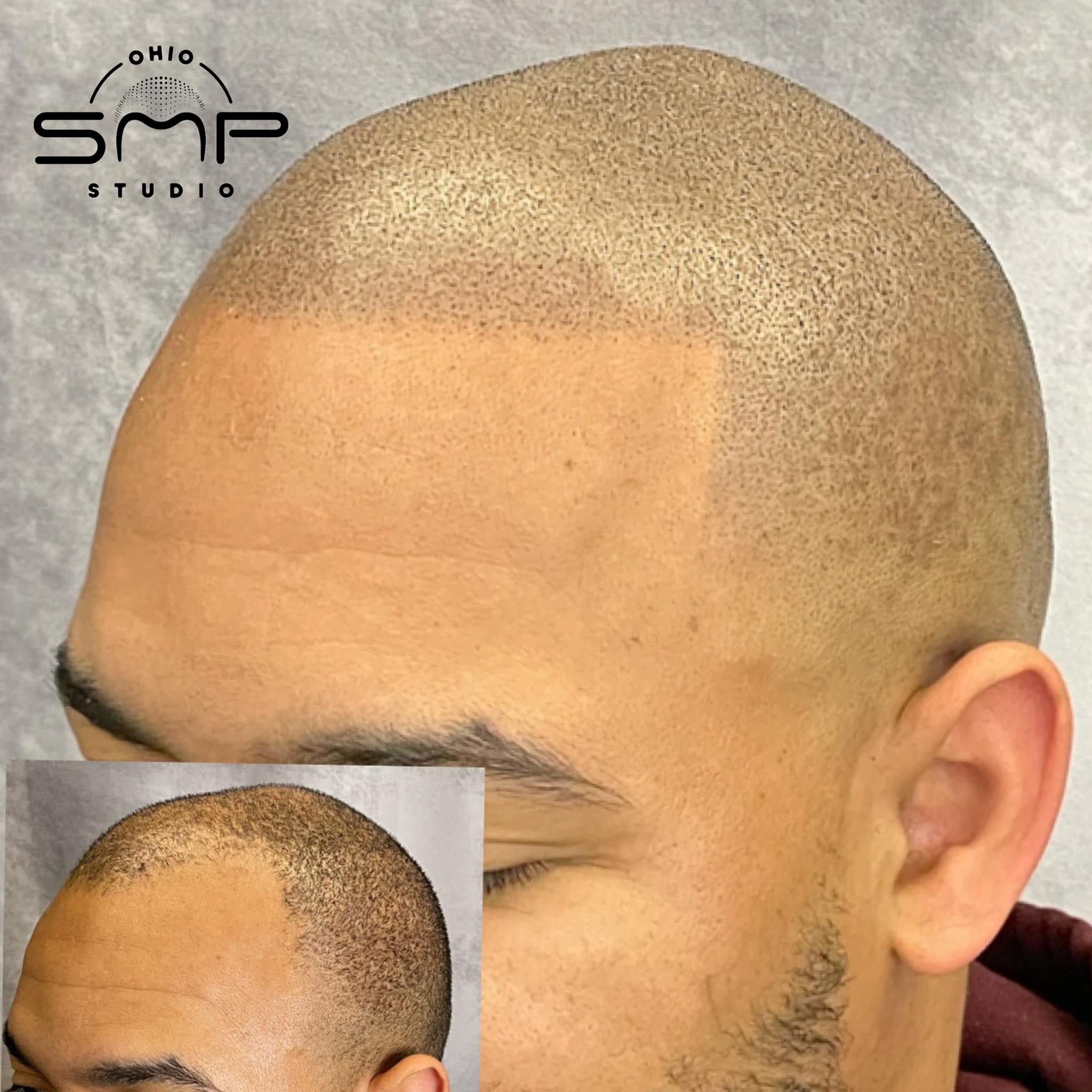Discover Scalp Micropigmentation The Best Hair Loss Solution in