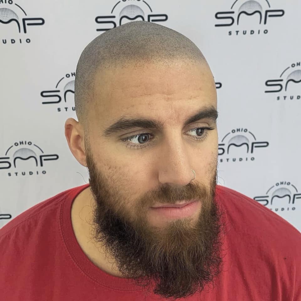 Scalp Micropigmentation in Richmond, VIC Embrace the SMP Transformation