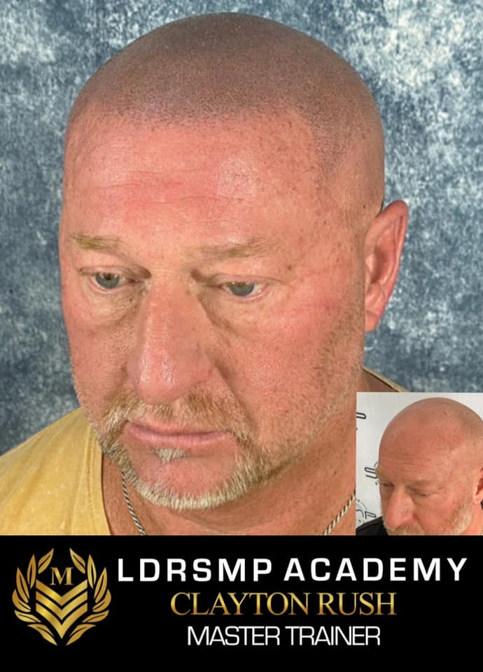 Unveiling the Longevity of Scalp Micropigmentation A Permanent Hair