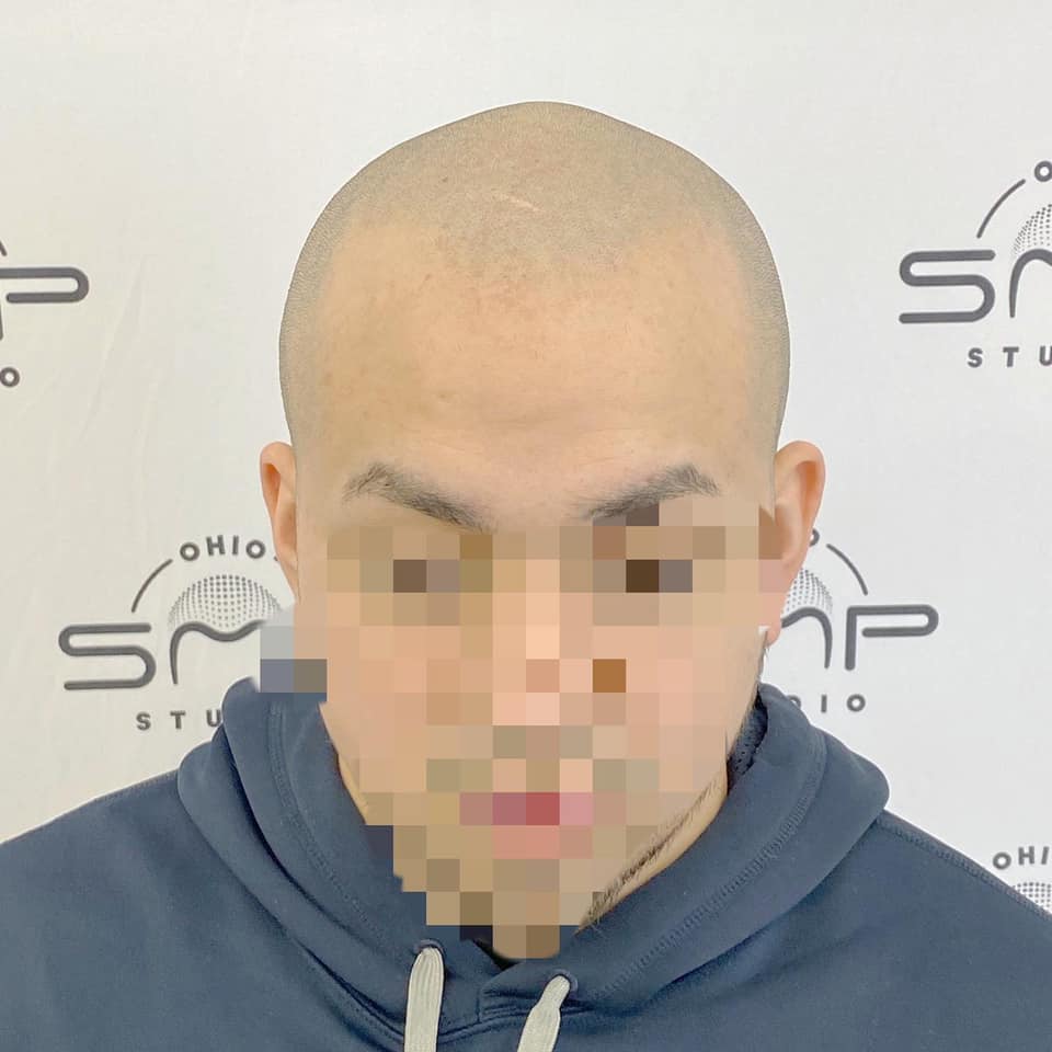 Nurturing Hair Health Decoding Vitamin D's Role Columbus, OH