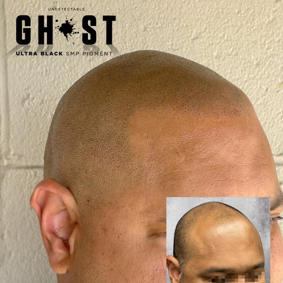 Reclaim Your Confidence Top Hair Loss Treatments for Men in Columbus, OH