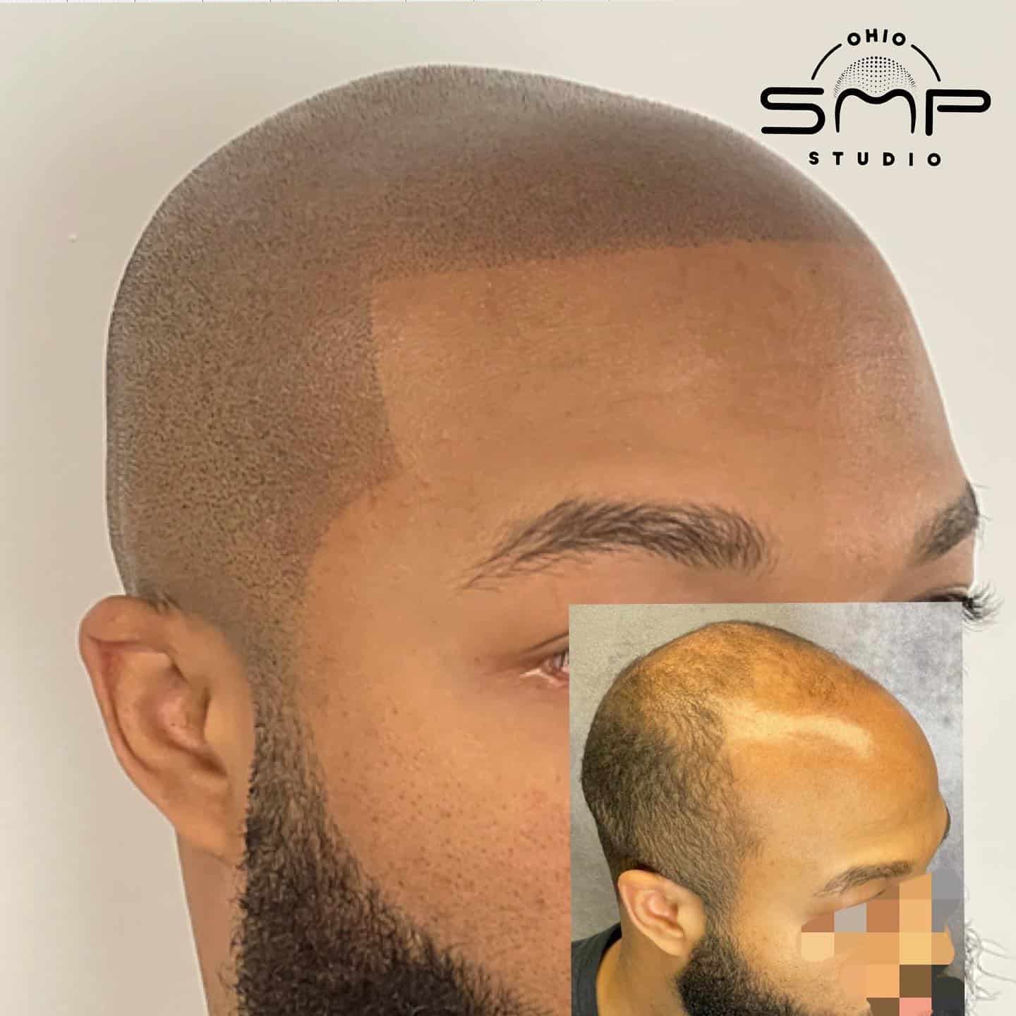Unlock the Power of SMP for Hair Restoration Ohio SMP Studio Columbus